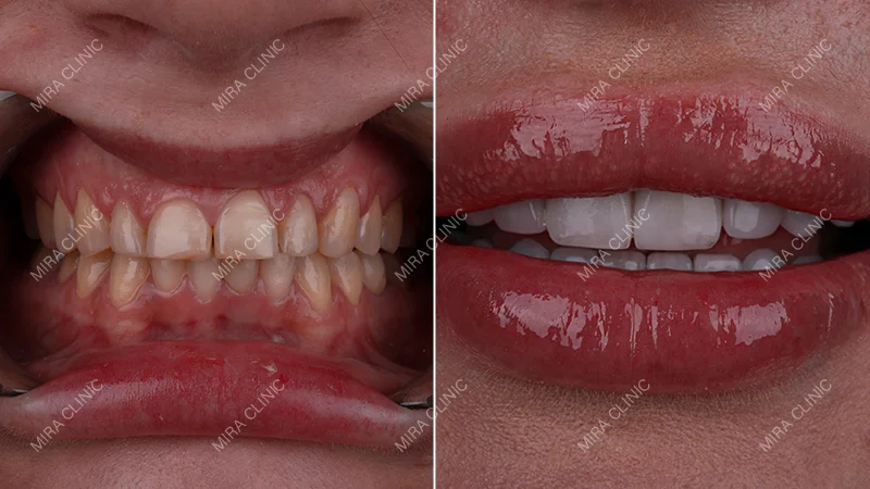 Before and After